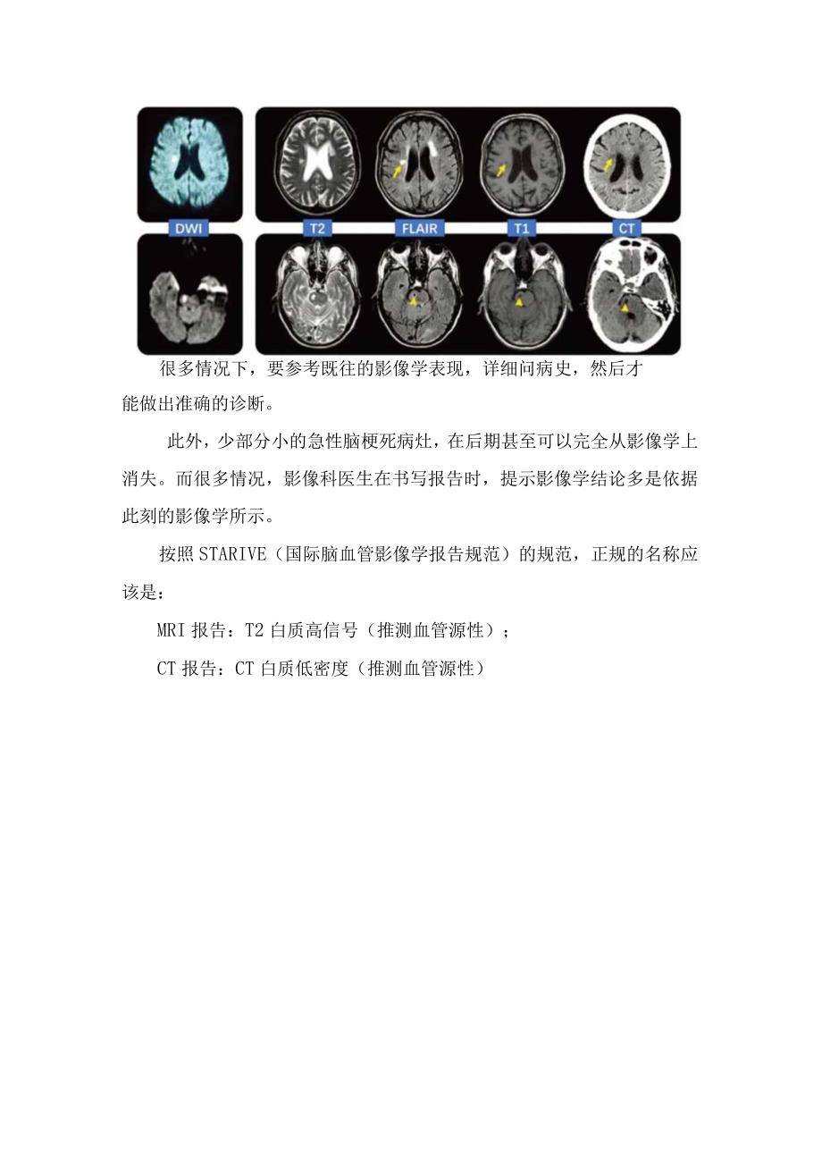 腔隙性脑梗死缺血灶脑白质等疾病影像学区别及病变联系.docx_第3页