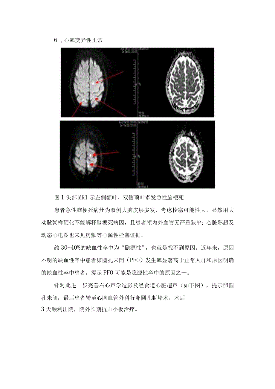 卵圆孔未闭导致急性脑卒中病例分享及卵圆孔未闭发病机制解剖特点危险因素和影像学鉴别诊断.docx_第2页