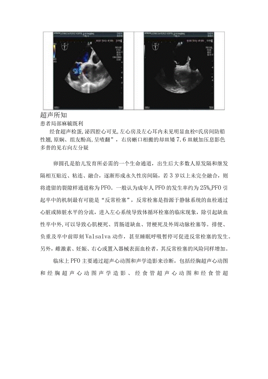 卵圆孔未闭导致急性脑卒中病例分享及卵圆孔未闭发病机制解剖特点危险因素和影像学鉴别诊断.docx_第3页