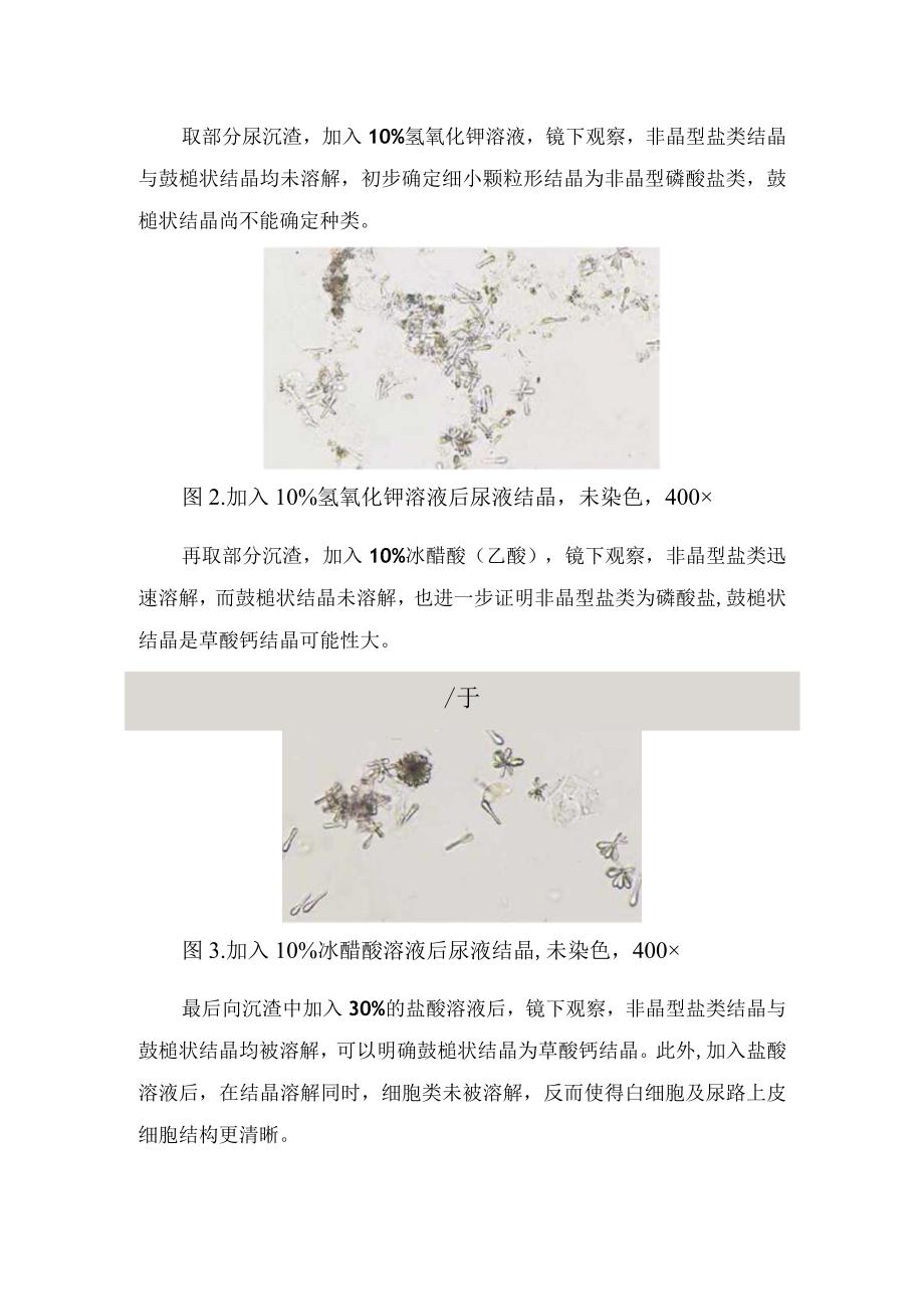 尿液特殊形态草酸钙结晶分析和鉴别流程.docx_第2页