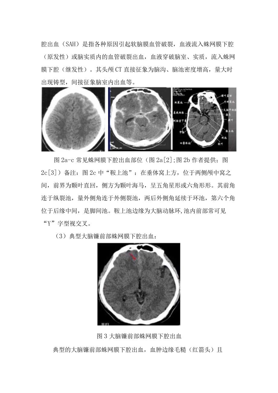 蛛网膜硬脑膜大脑镰及小脑幕等解剖结构影像学表现及蛛网膜下腔出血硬膜下血肿诊断和鉴别诊断.docx_第2页