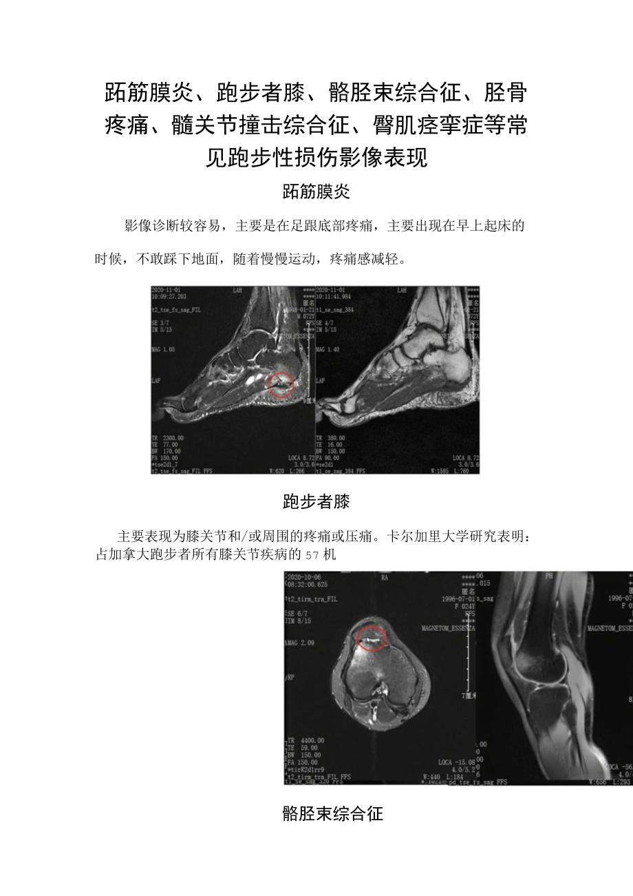 跖筋膜炎跑步者膝髂胫束综合征胫骨疼痛髋关节撞击综合征臀肌痉挛症等常见跑步性损伤影像表现.docx_第1页