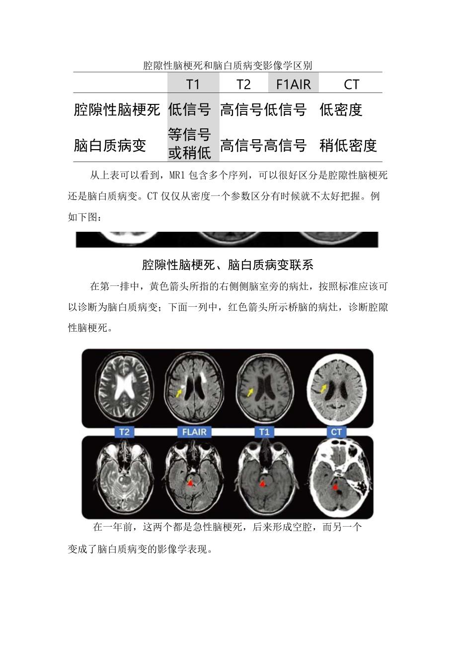 腔隙性脑梗死缺血灶脑白质等疾病影像学区别及病变联系.docx_第2页