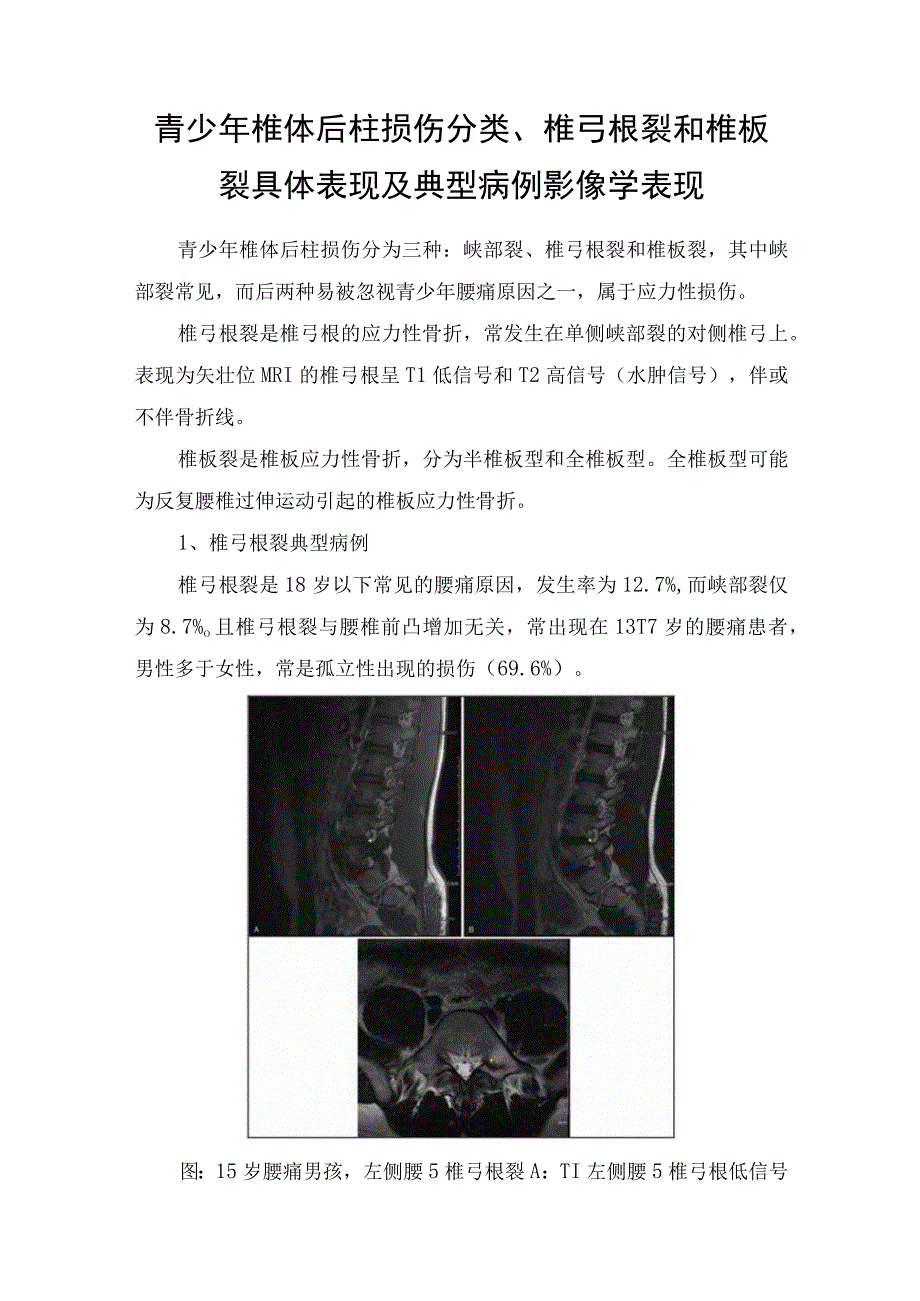 青少年椎体后柱损伤分类椎弓根裂和椎板裂具体表现及典型病例影像学表现.docx_第1页