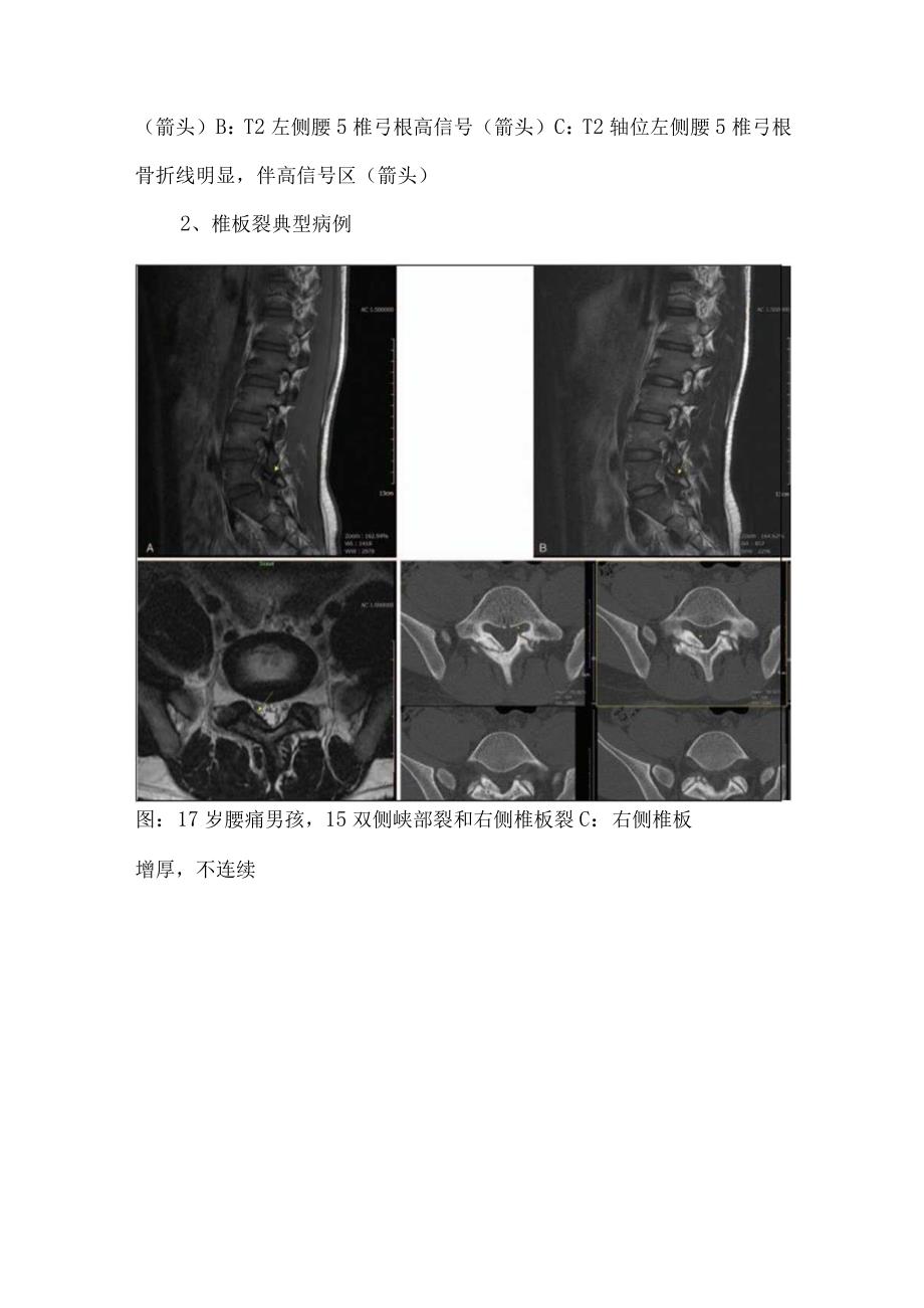 青少年椎体后柱损伤分类椎弓根裂和椎板裂具体表现及典型病例影像学表现.docx_第2页