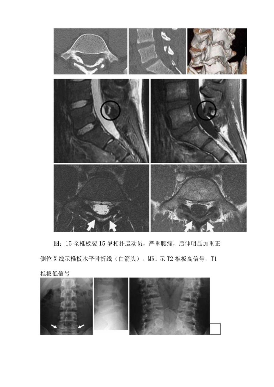 青少年椎体后柱损伤分类椎弓根裂和椎板裂具体表现及典型病例影像学表现.docx_第3页