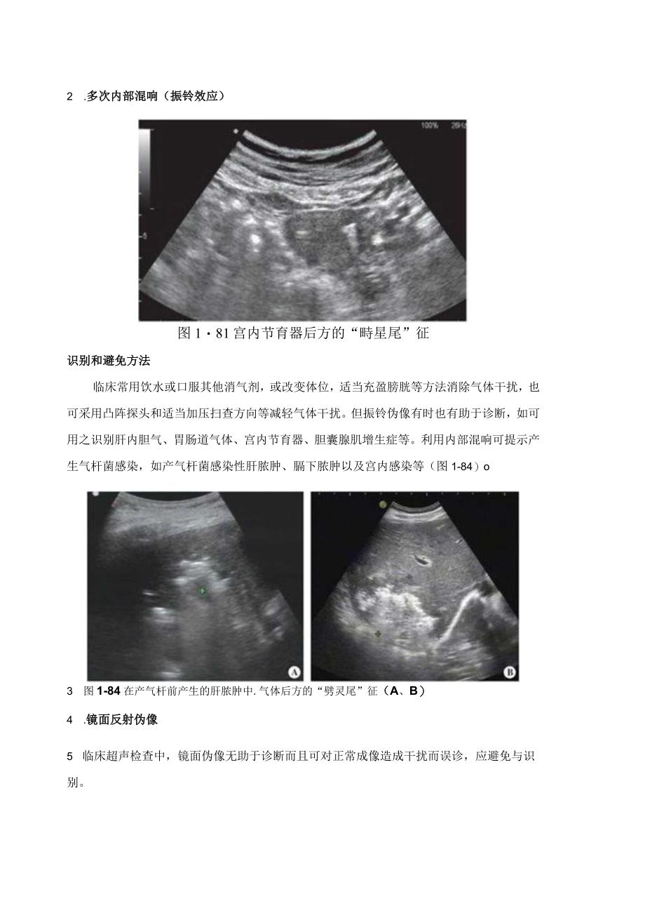 16种常见超声伪像的识别和避免方法.docx_第2页