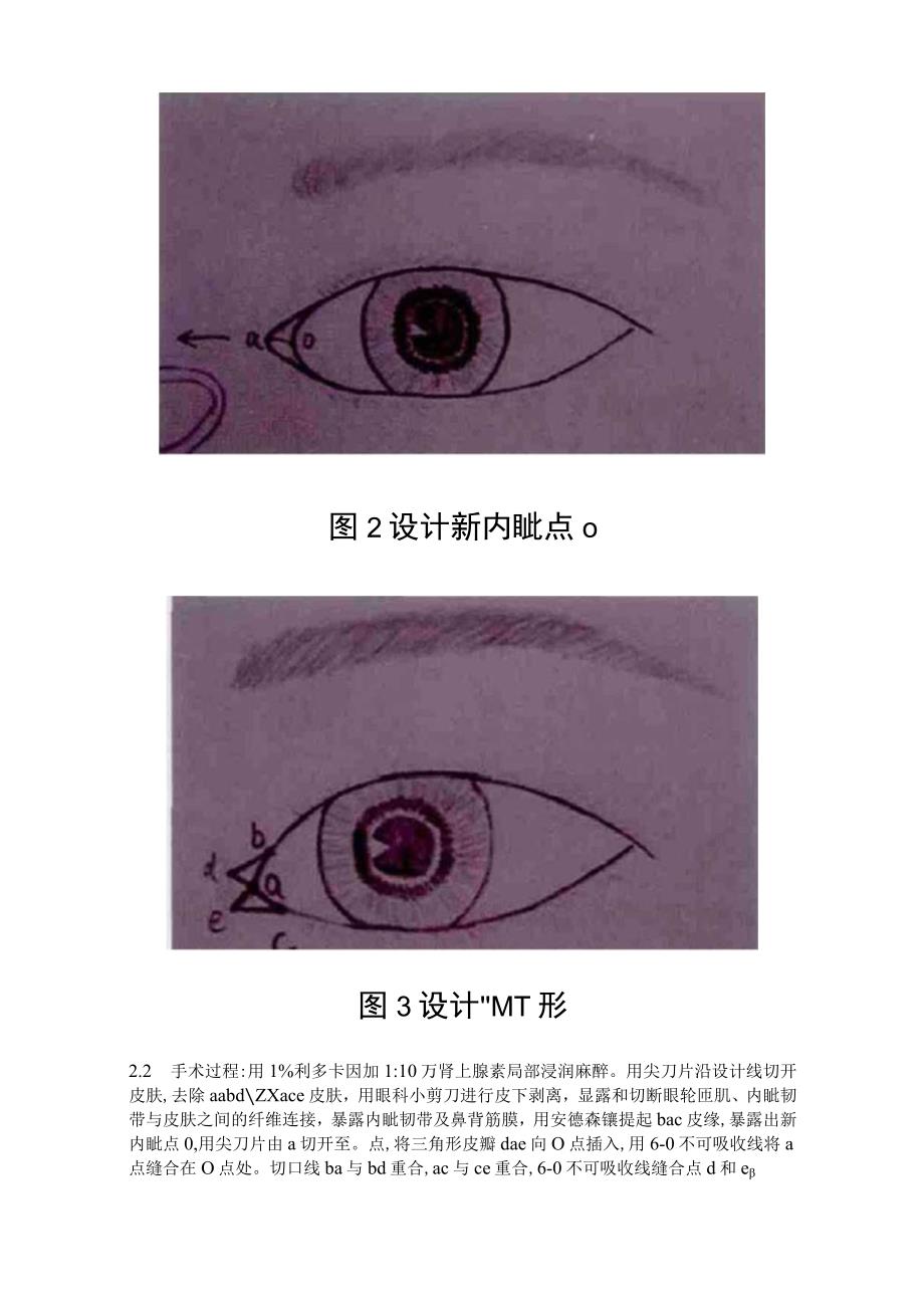 医疗美容内眦赘皮矫正术知识.docx_第3页