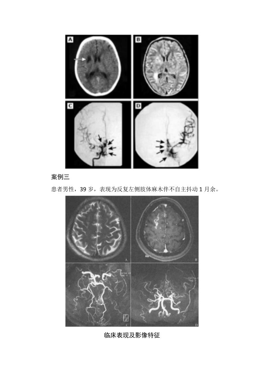 临床烟雾病病例分享临床表现和影像学特征.docx_第2页