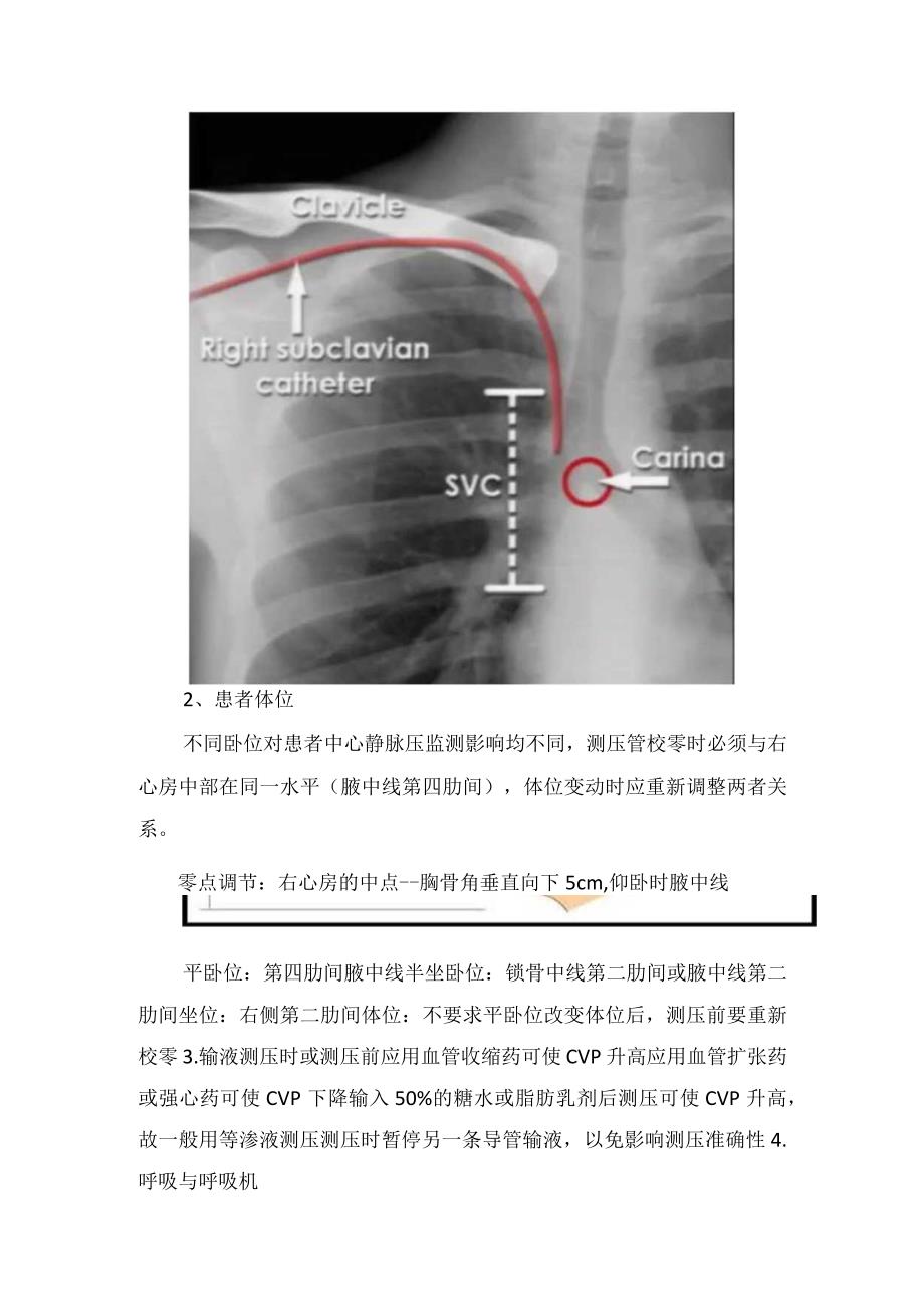 临床中心静脉压临床意义测量测量影响因素测量方法操作方法及心包填塞病例分享.docx_第3页