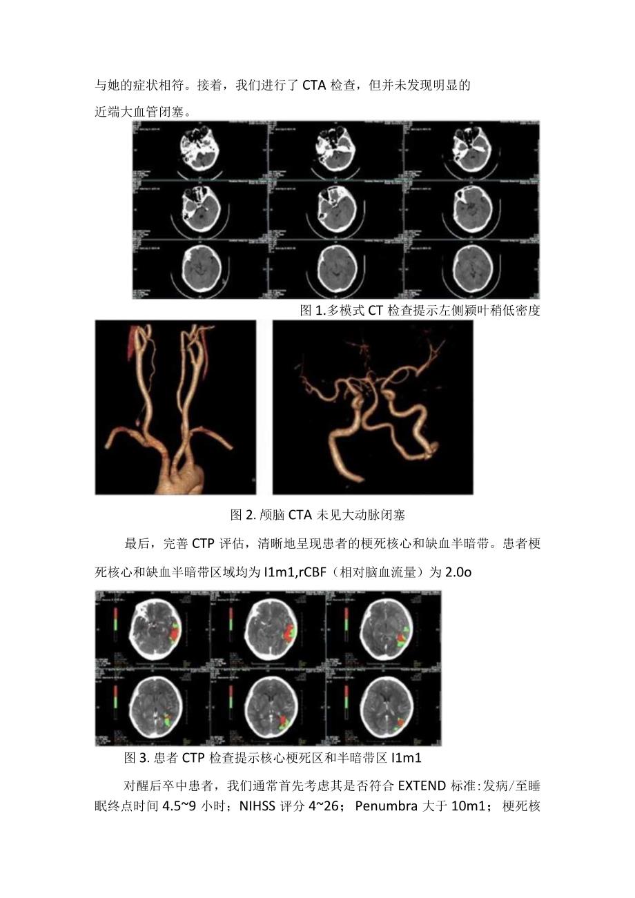 临床醒后卒中静脉溶栓治疗病例分享及要点总结.docx_第2页