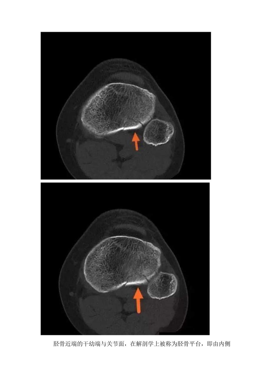 临床外伤膝关节病例分享影像学表现和诊断要点.docx_第2页