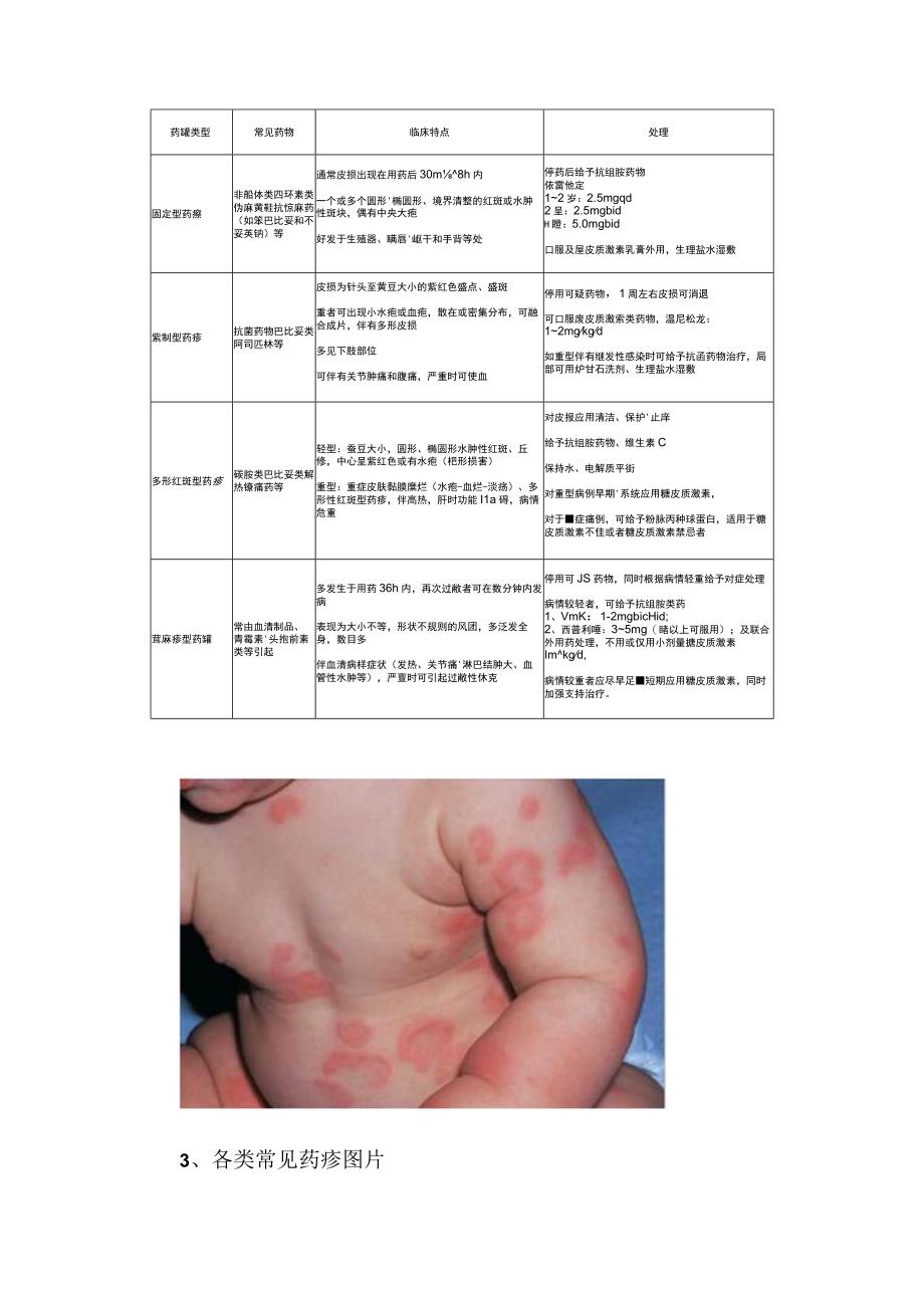 临床发热伴皮疹病例分享皮疹特点诊断思路辨别各类特征及多形性红斑药疹紫癜型药疹荨麻疹型药疹等临床表现.docx_第3页