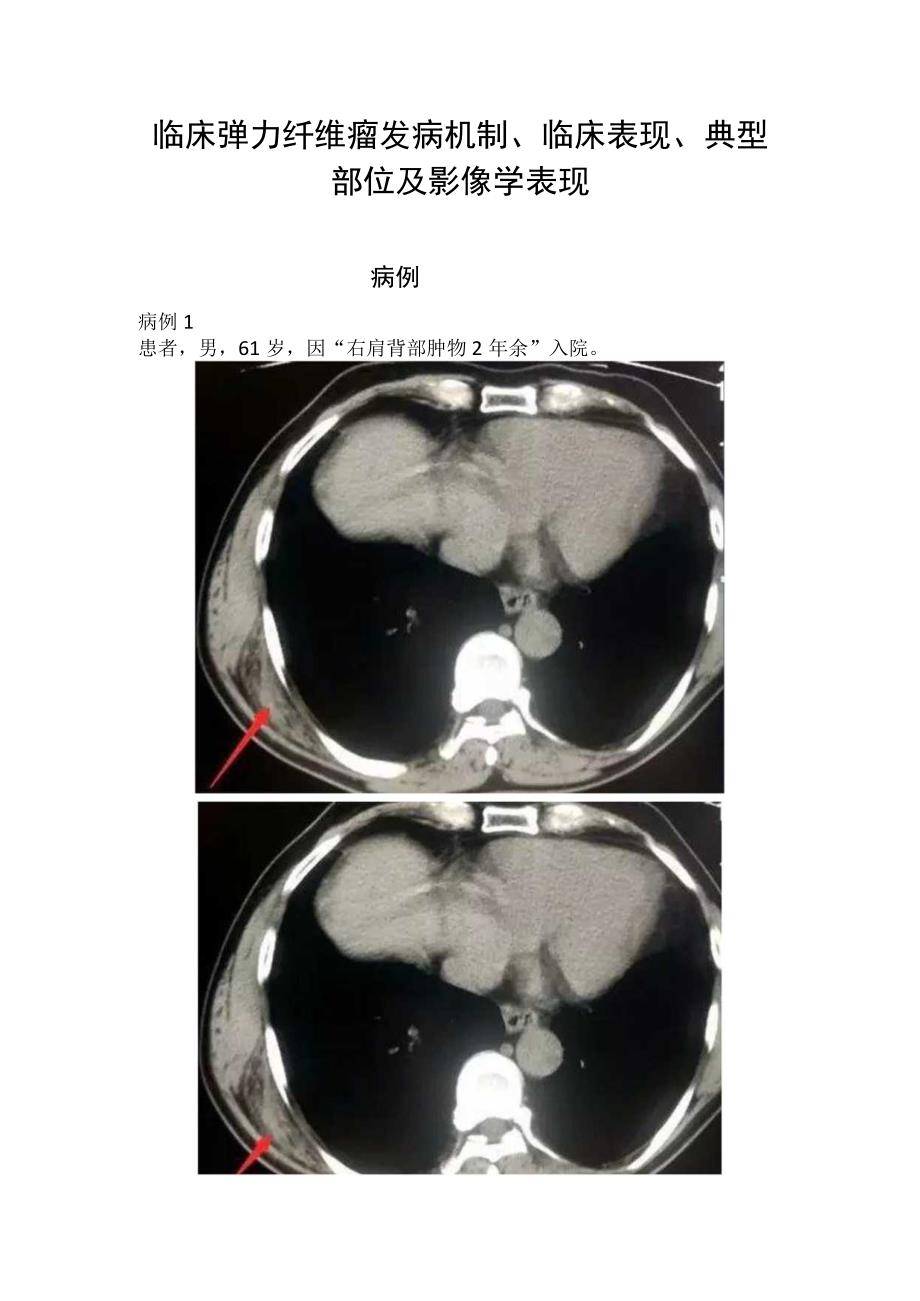 临床弹力纤维瘤发病机制临床表现典型部位及影像学表现.docx_第1页