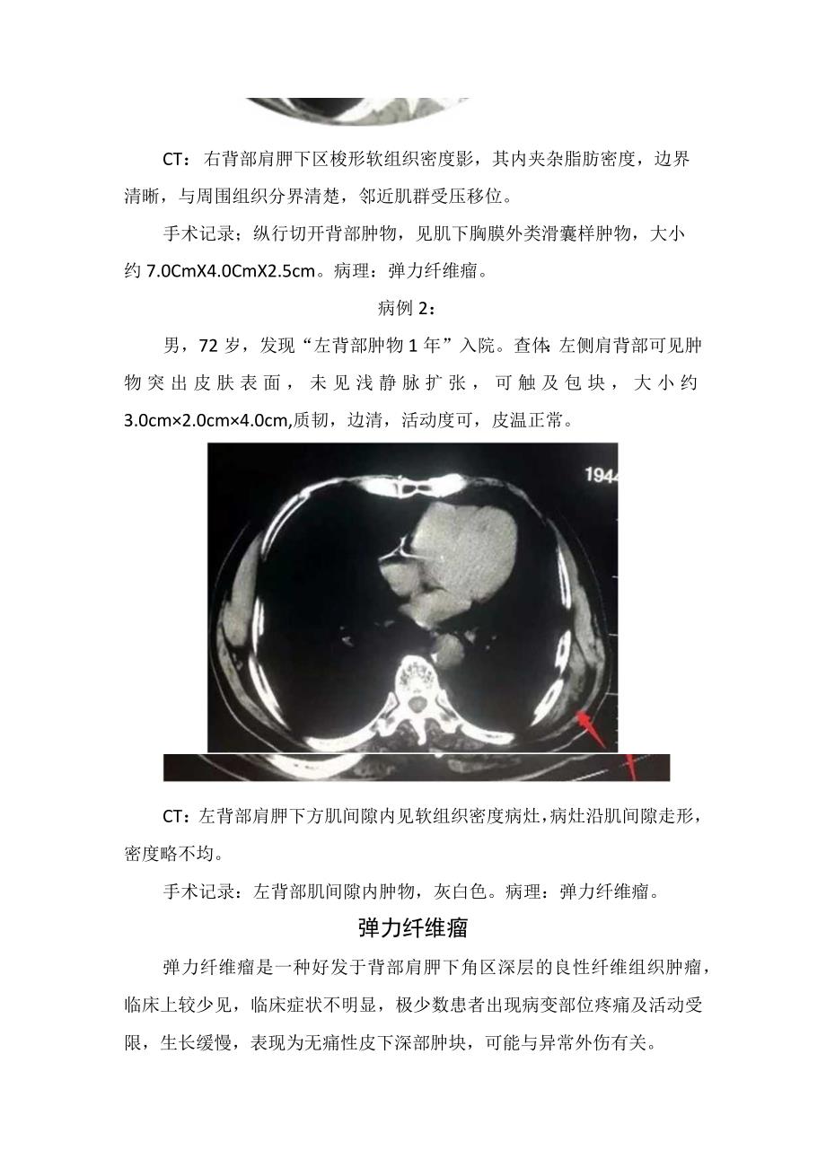 临床弹力纤维瘤发病机制临床表现典型部位及影像学表现.docx_第2页