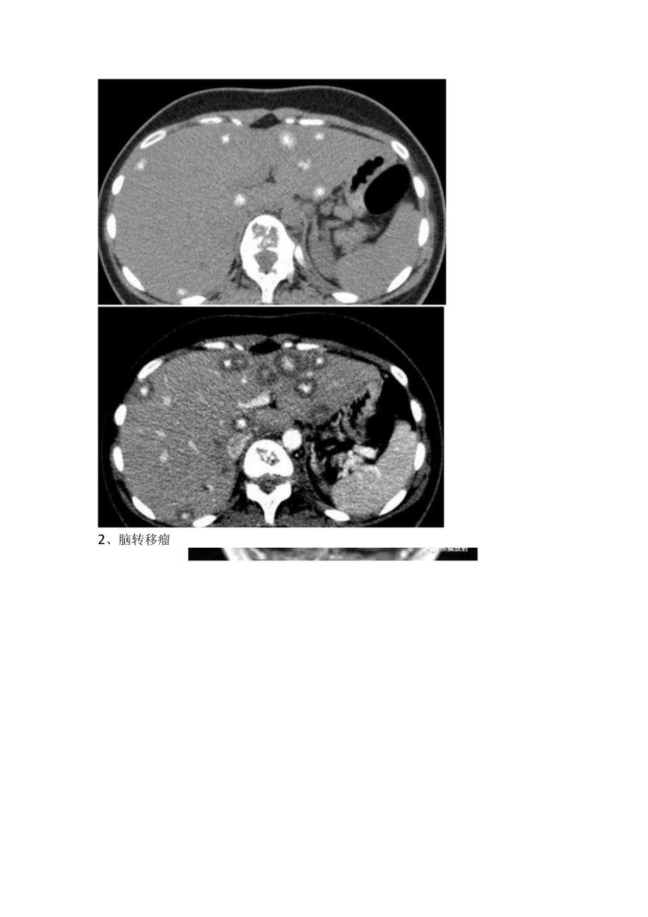临床肝结核脑脓肿脑转移瘤弓形体脑病脑结核瘤肠套叠空肠黑色素瘤等转移性肝癌病变影像学表现.docx_第3页