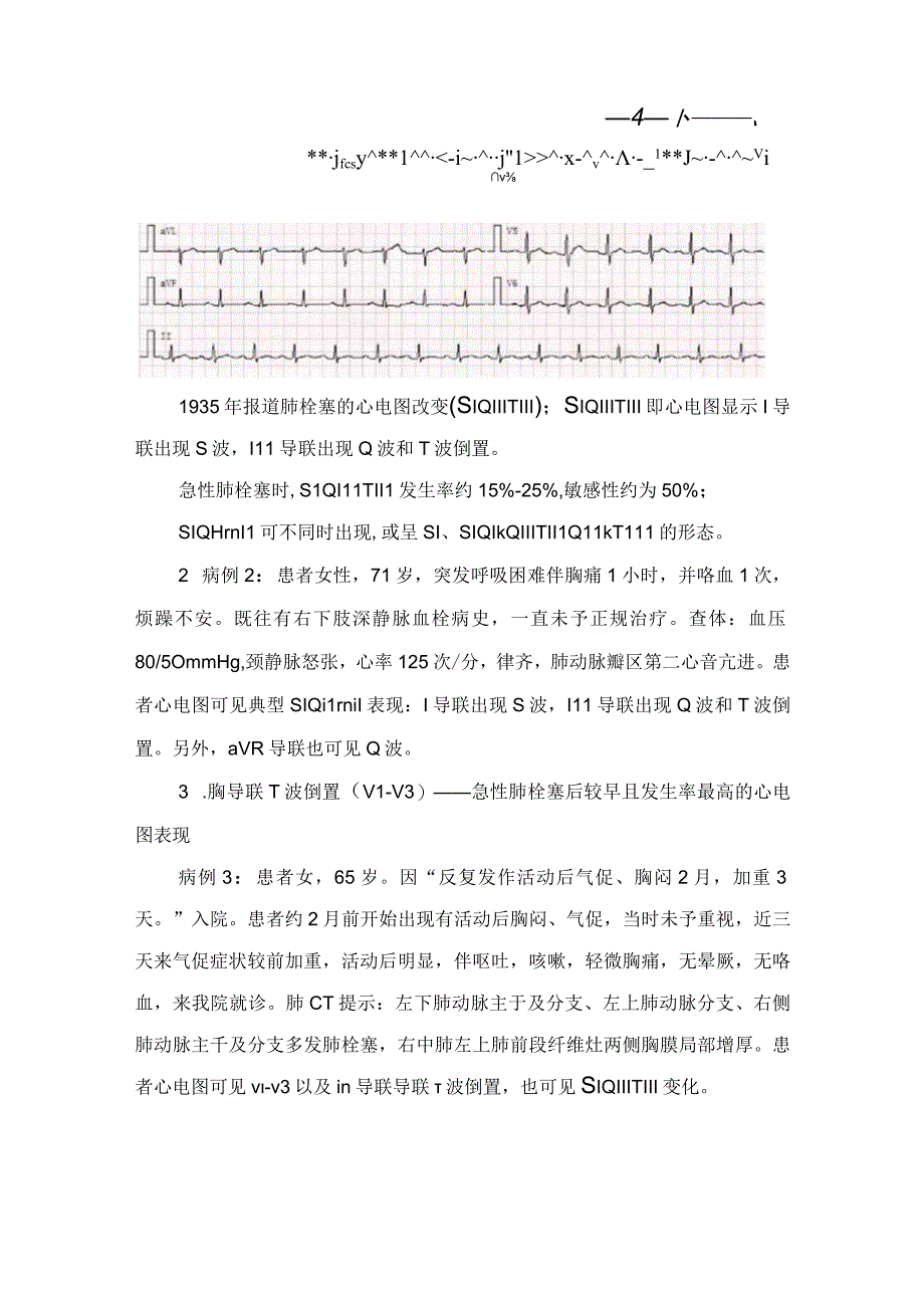 临床急性肺栓塞病理生理12导联体表心电图改变心电图评分及要点总结.docx_第2页