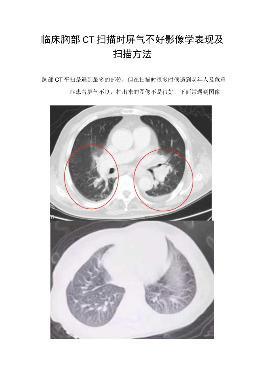 临床胸部CT扫描时屏气不好影像学表现及扫描方法.docx_第1页