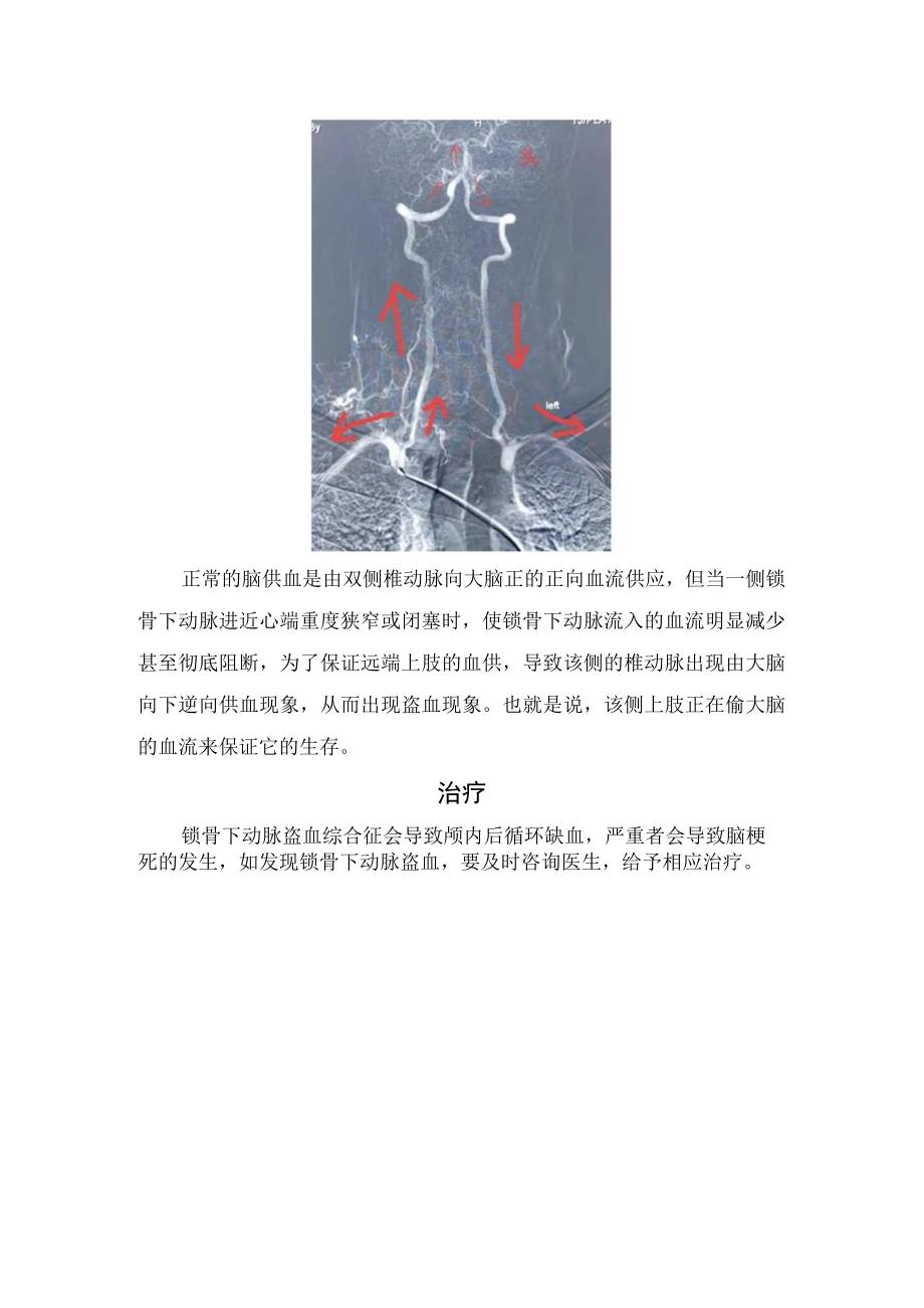 锁骨下动脉盗血综合征病例分享发病机制及治疗措施.docx_第2页