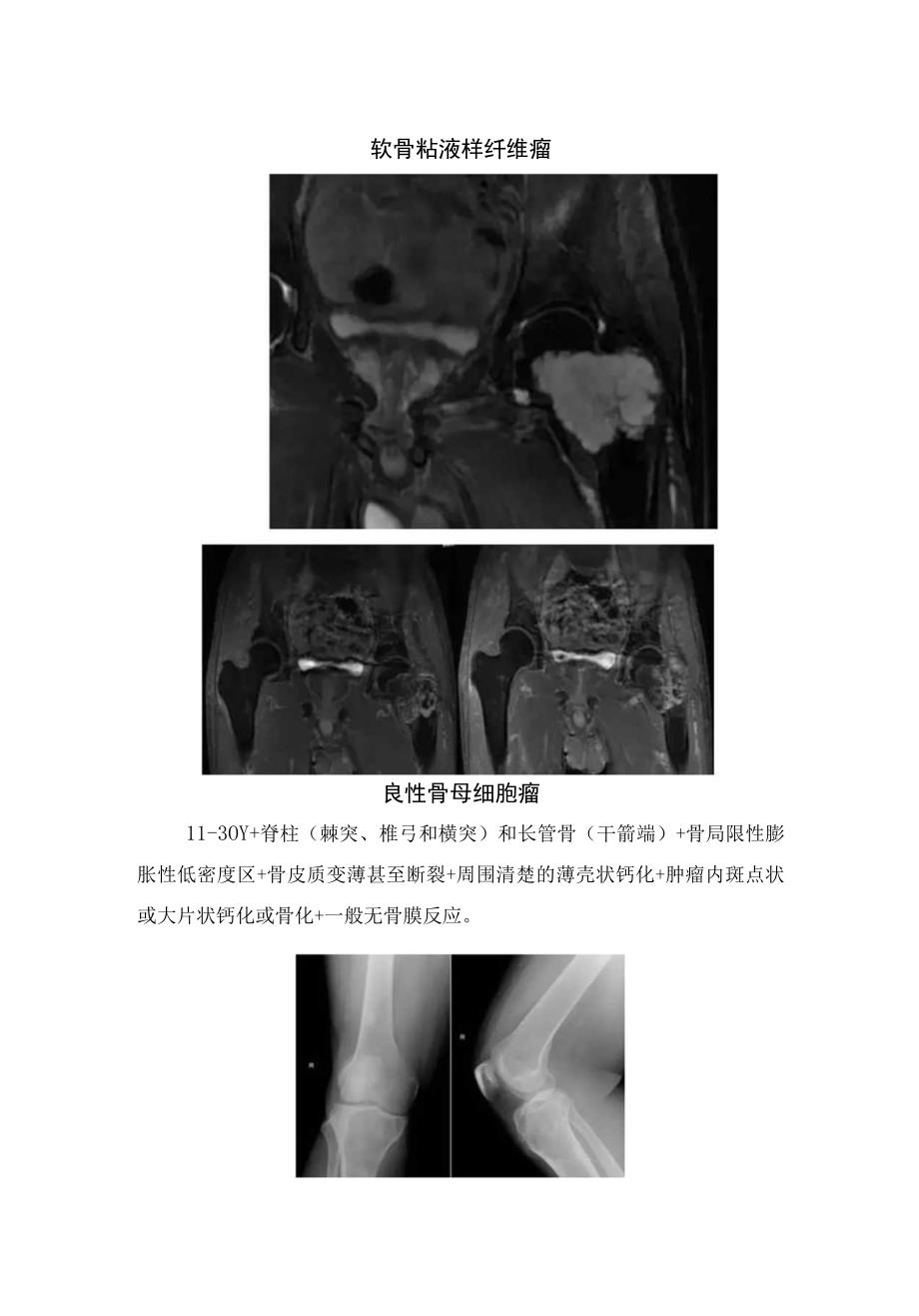 骨囊肿软骨肉瘤软骨粘液样纤维瘤良性骨母细胞瘤良性骨母细胞瘤骨巨细胞瘤非骨化性纤维瘤内生软骨瘤脊柱转移瘤骨肉瘤.docx_第3页