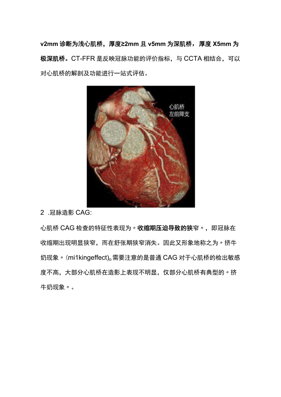 2024心肌桥的诊断与治疗.docx_第3页