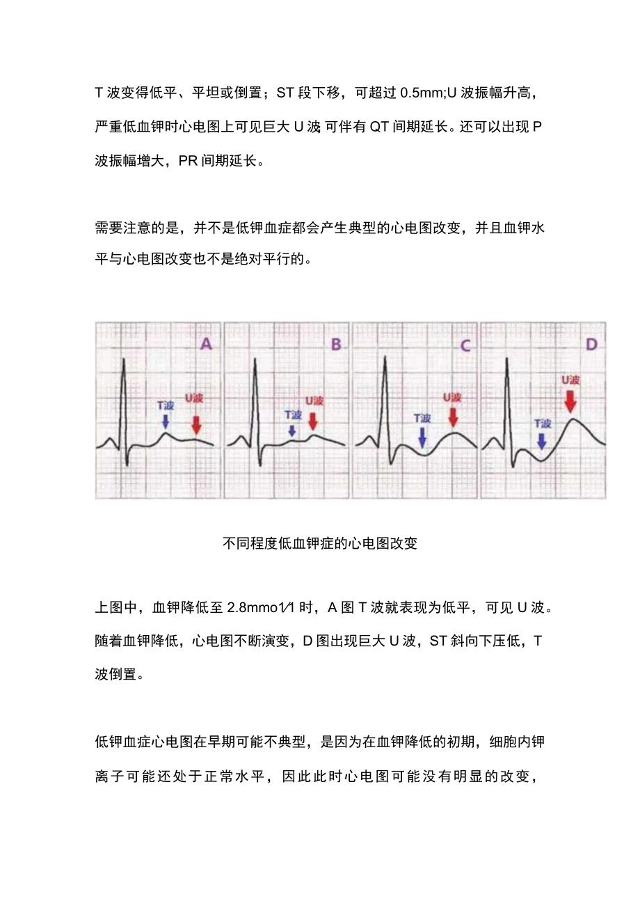 2024低钾血症的诊疗思路.docx_第2页