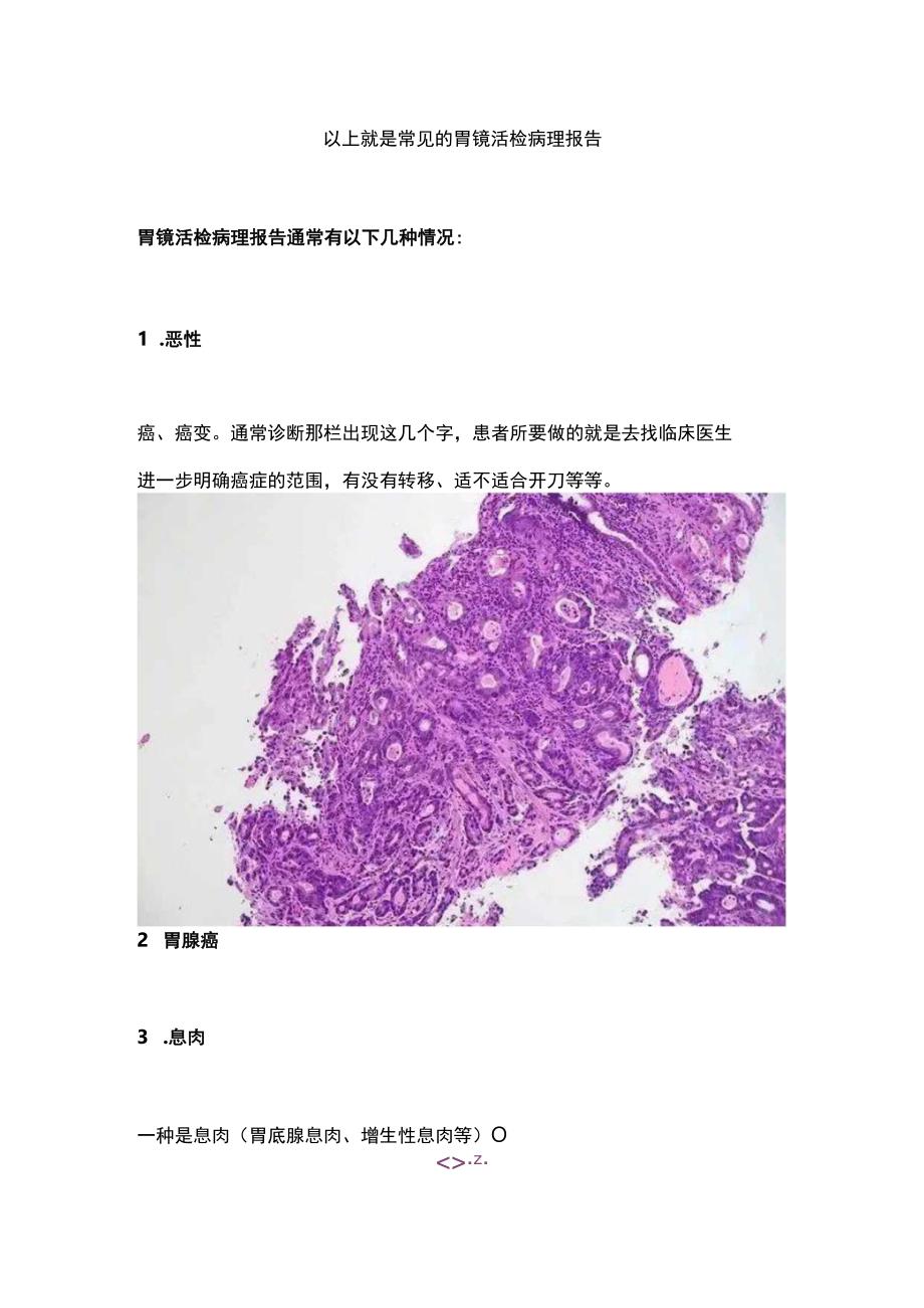 2024胃镜活检病理报告.docx_第2页