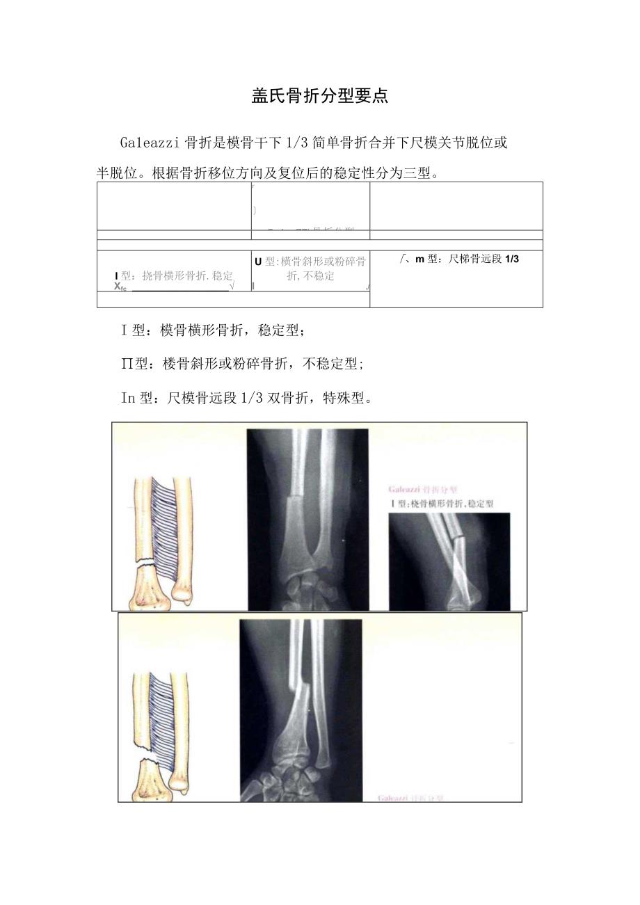 盖氏骨折分型要点.docx_第1页