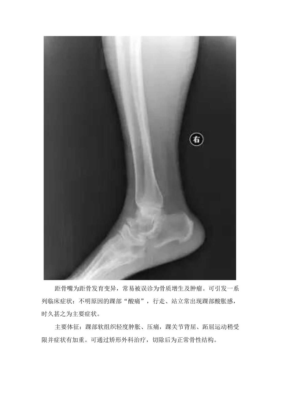 距骨嘴临床表现、主要体征及影像学表现.docx_第2页