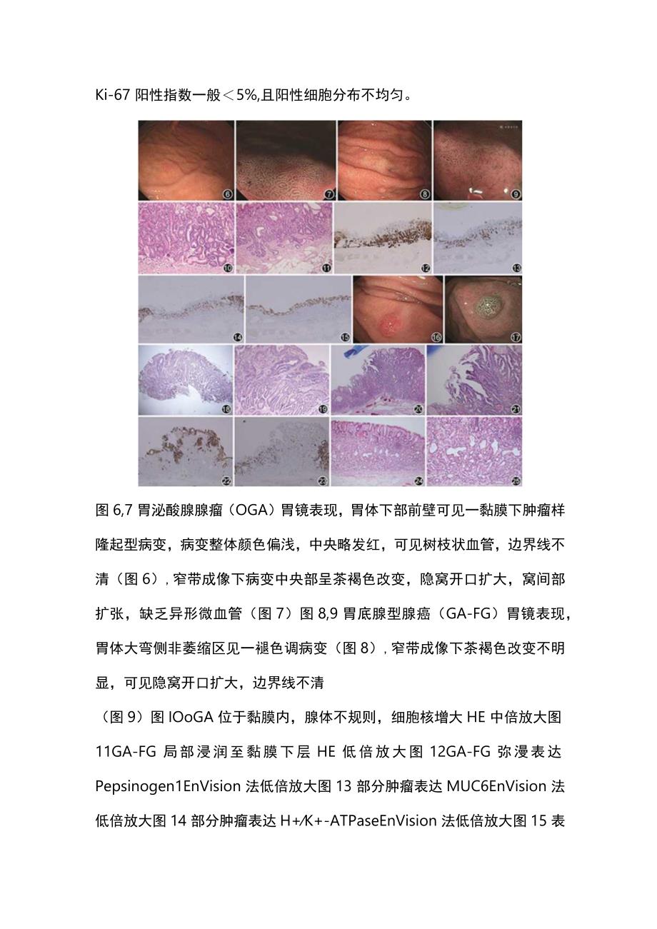 2024胃底腺型肿瘤临床及病理学特点.docx_第3页