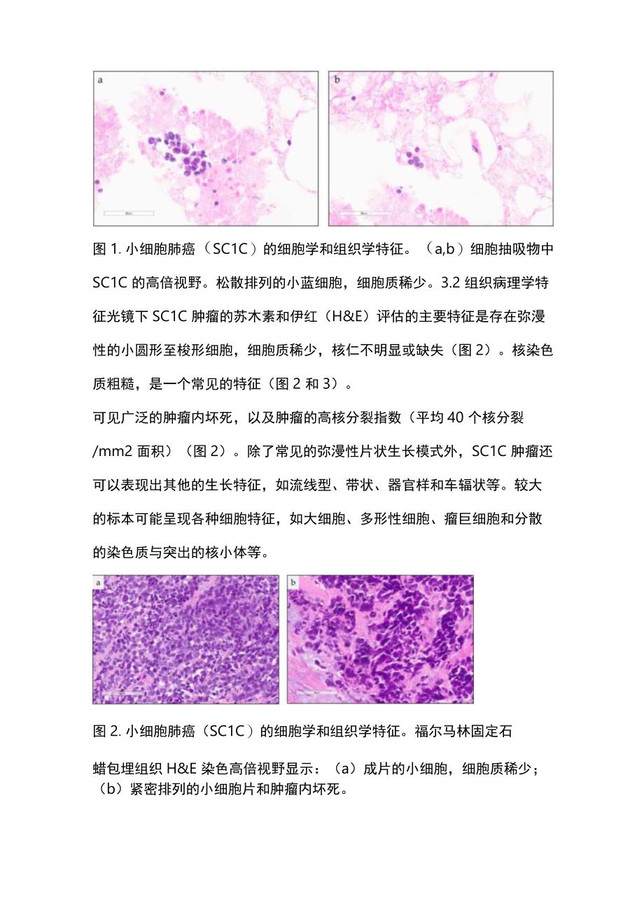 2024小细胞肺癌病理诊断要点.docx_第3页