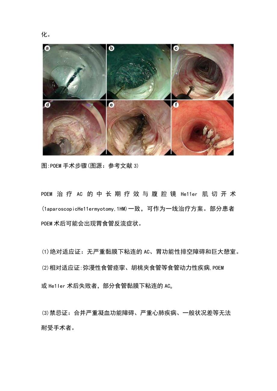 2024贲门失弛缓症的治疗方法.docx_第3页