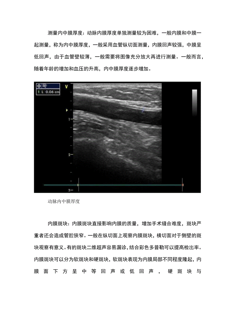 上肢血管通路术前超声评估.docx_第1页