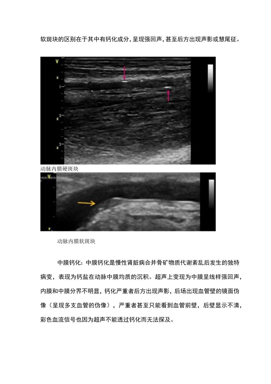 上肢血管通路术前超声评估.docx_第2页