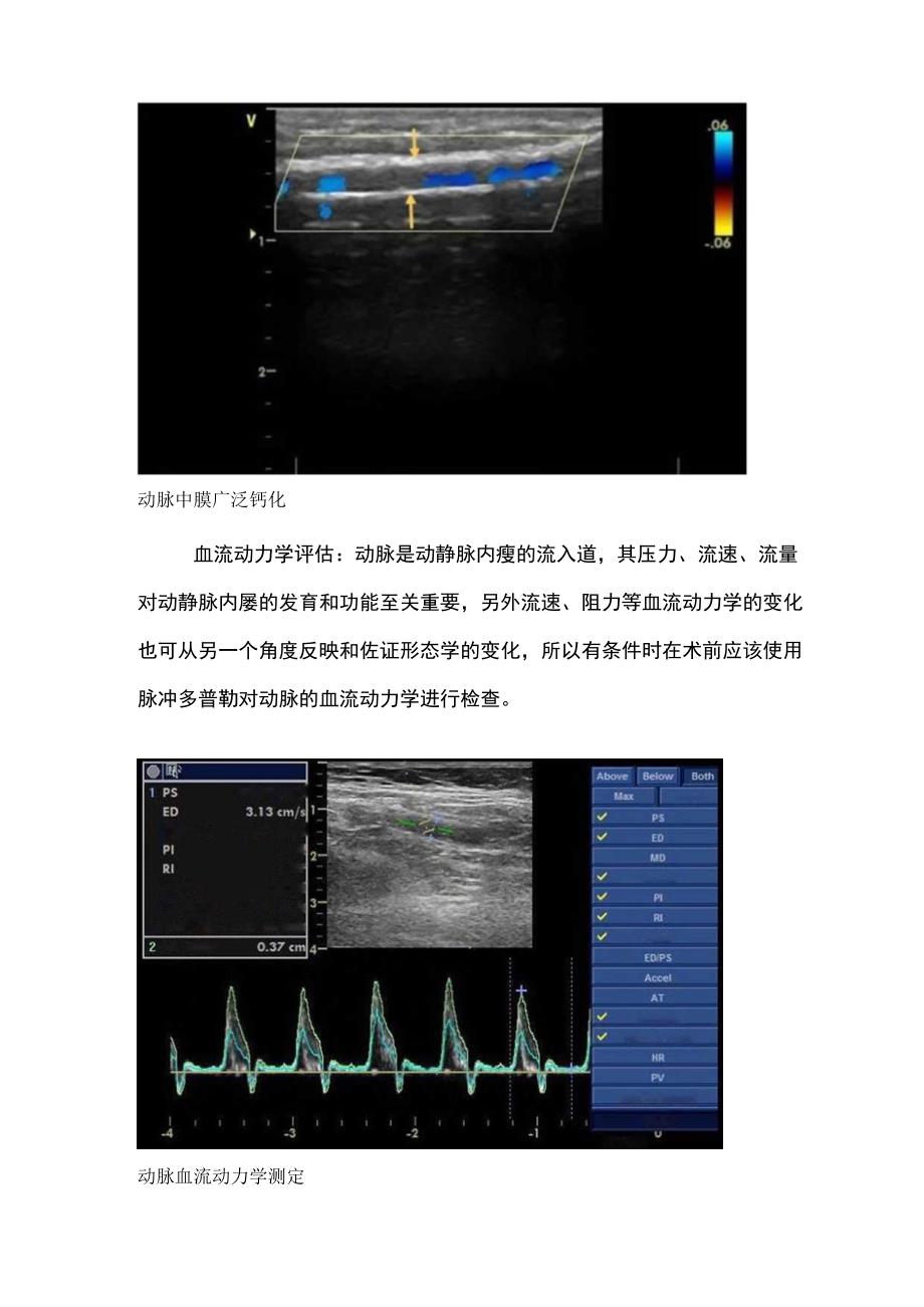 上肢血管通路术前超声评估.docx_第3页