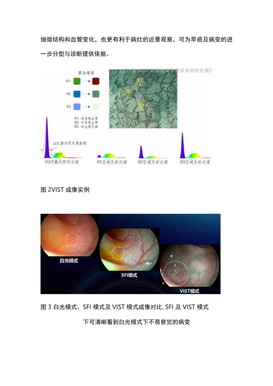 国产自研特殊光技术在消化道早癌诊疗的应用进展2024.docx_第2页