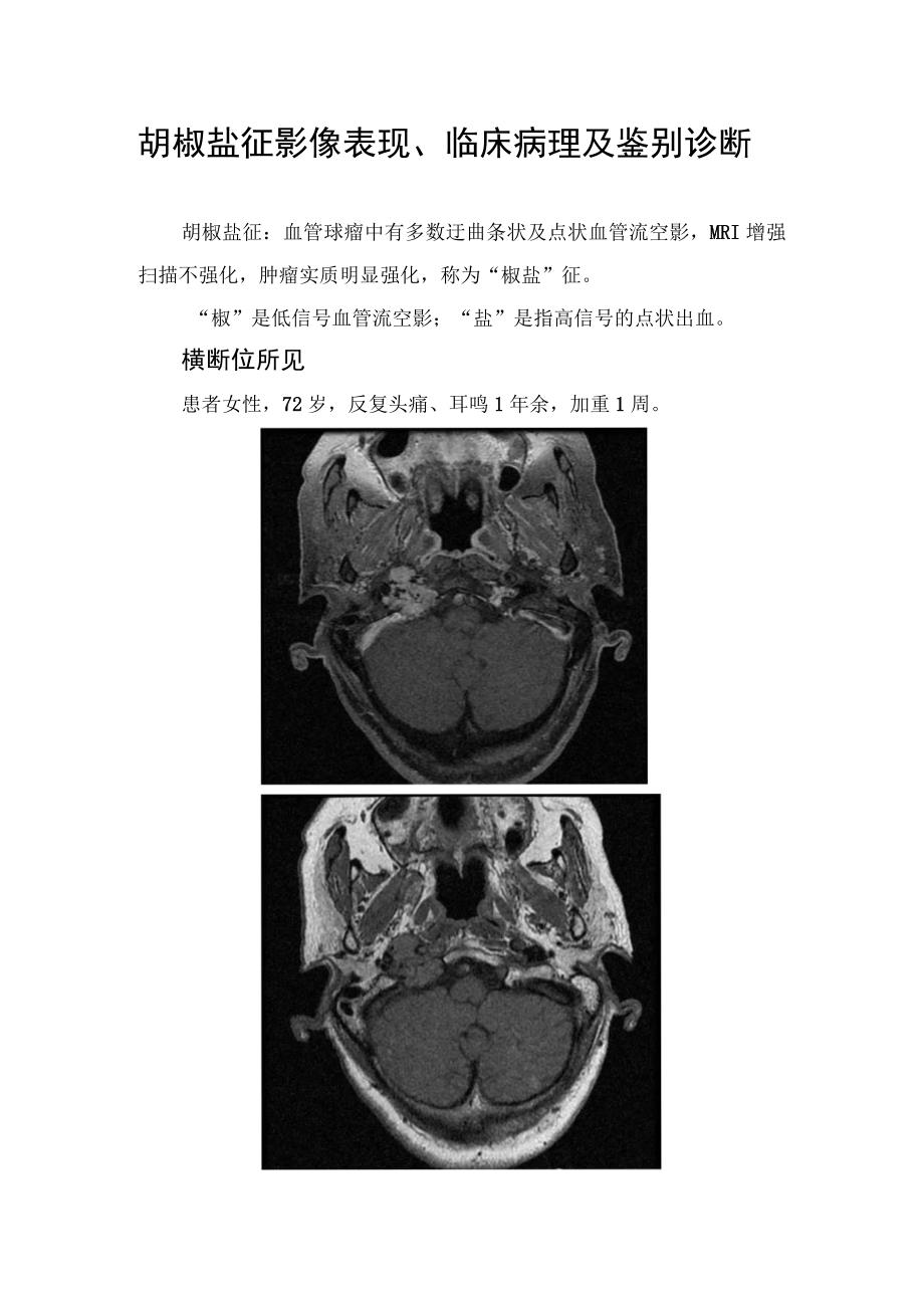 胡椒盐征影像表现、临床病理及鉴别诊断.docx_第1页