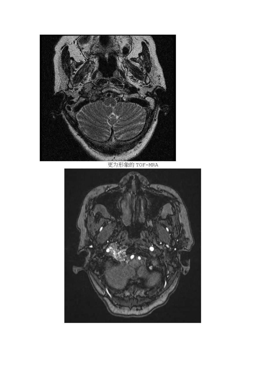 胡椒盐征影像表现、临床病理及鉴别诊断.docx_第2页