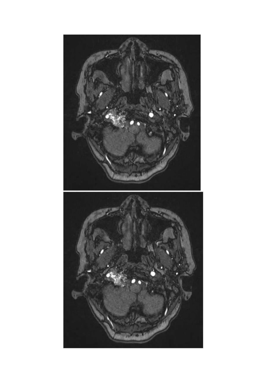 胡椒盐征影像表现、临床病理及鉴别诊断.docx_第3页