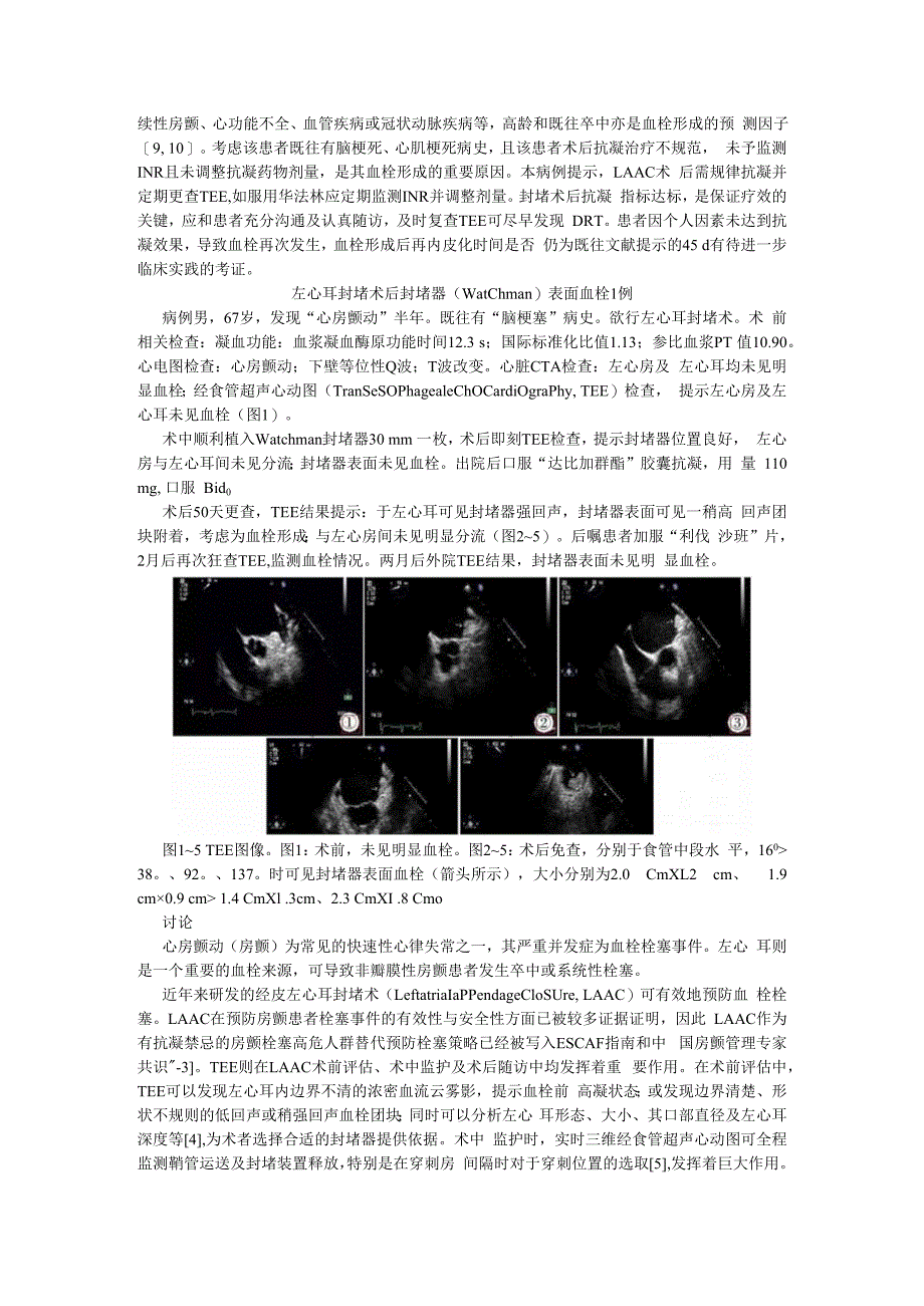 （病例报告）左心耳封堵器血栓两例.docx_第3页