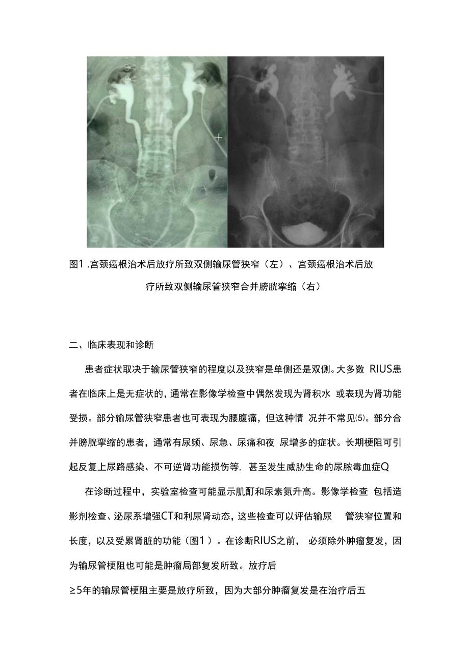 2023放疗所致输尿管狭窄的临床诊疗进展.docx_第2页