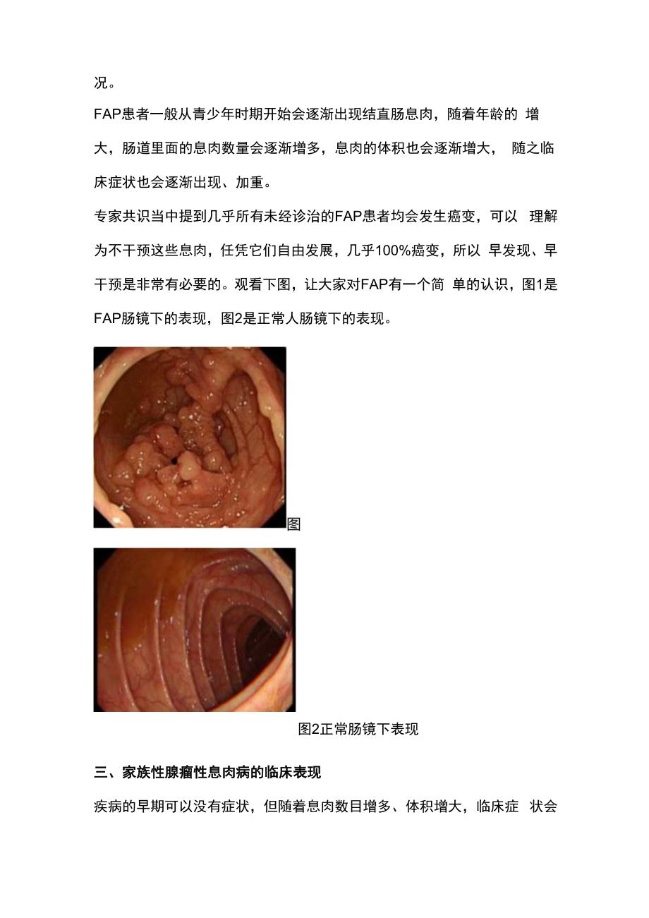 2024家族性腺瘤性息肉病.docx_第2页