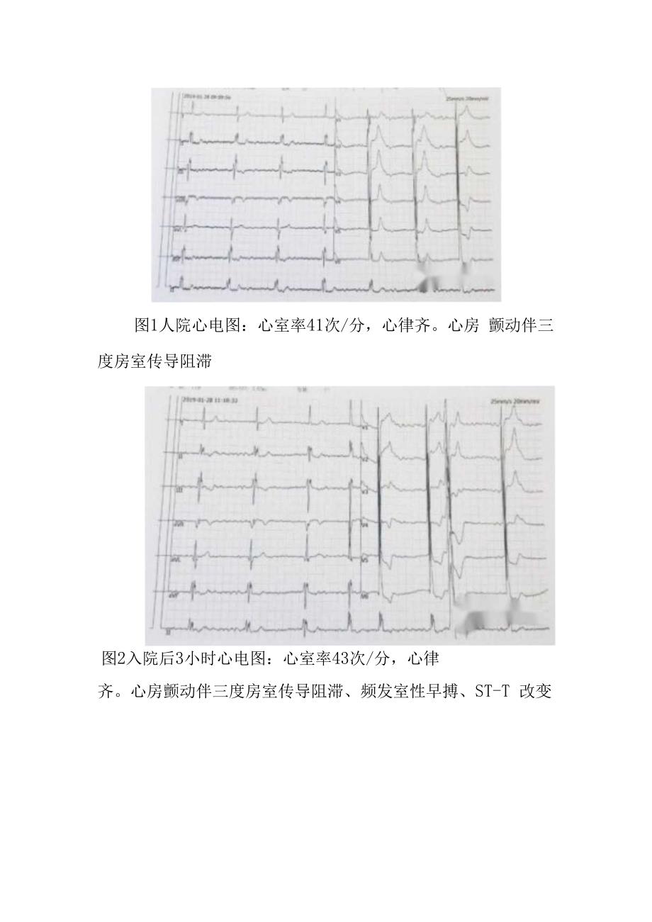 内科地高辛中毒病例分析专题报告.docx_第3页