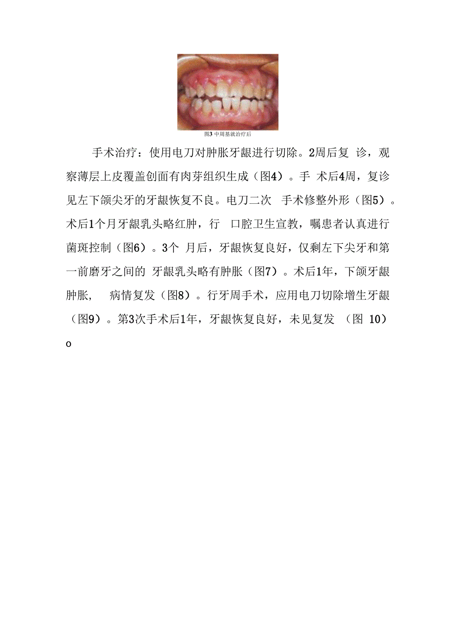 口腔科医师晋升副主任医师病例分析专题报告（牙龈红肿病）.docx_第3页