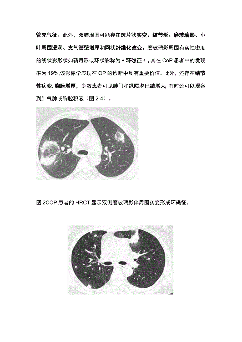 隐源性机化性肺炎的临床特征和诊断要点2024.docx_第3页