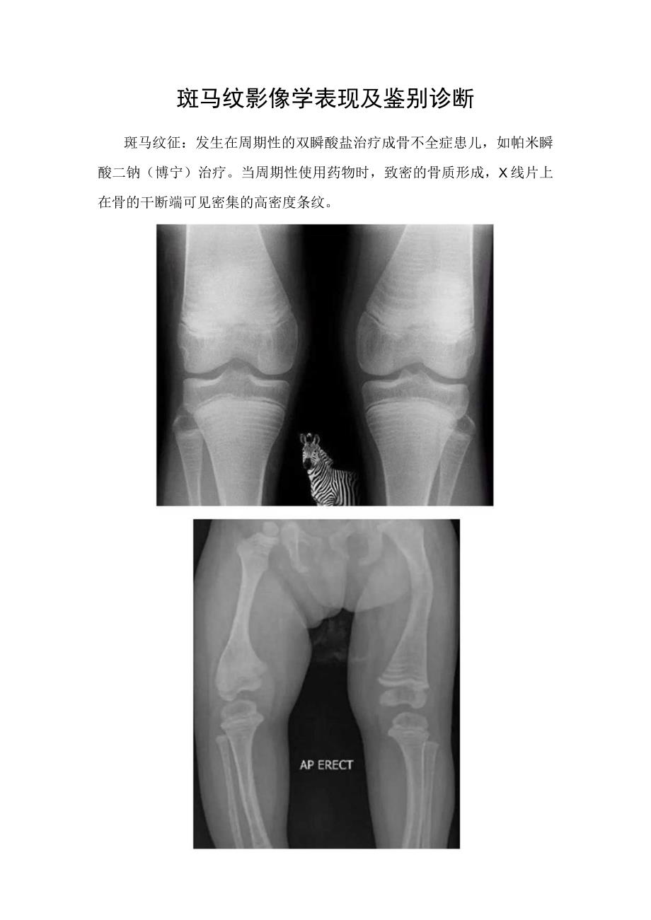 斑马纹影像学表现及鉴别诊断.docx_第1页