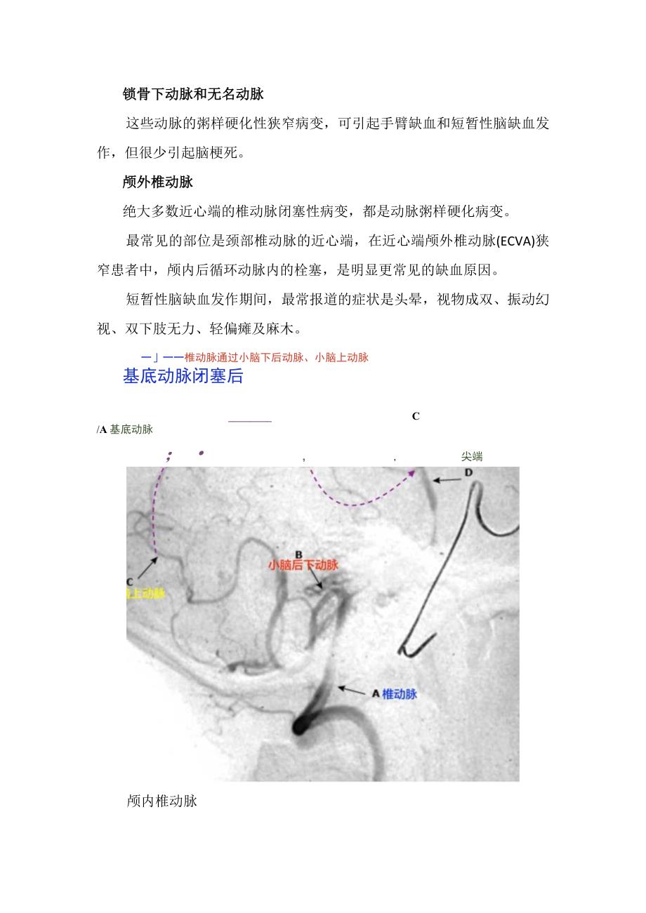 临床后循环脑血管综合征缺血和头晕发病机制及临床表现.docx_第2页