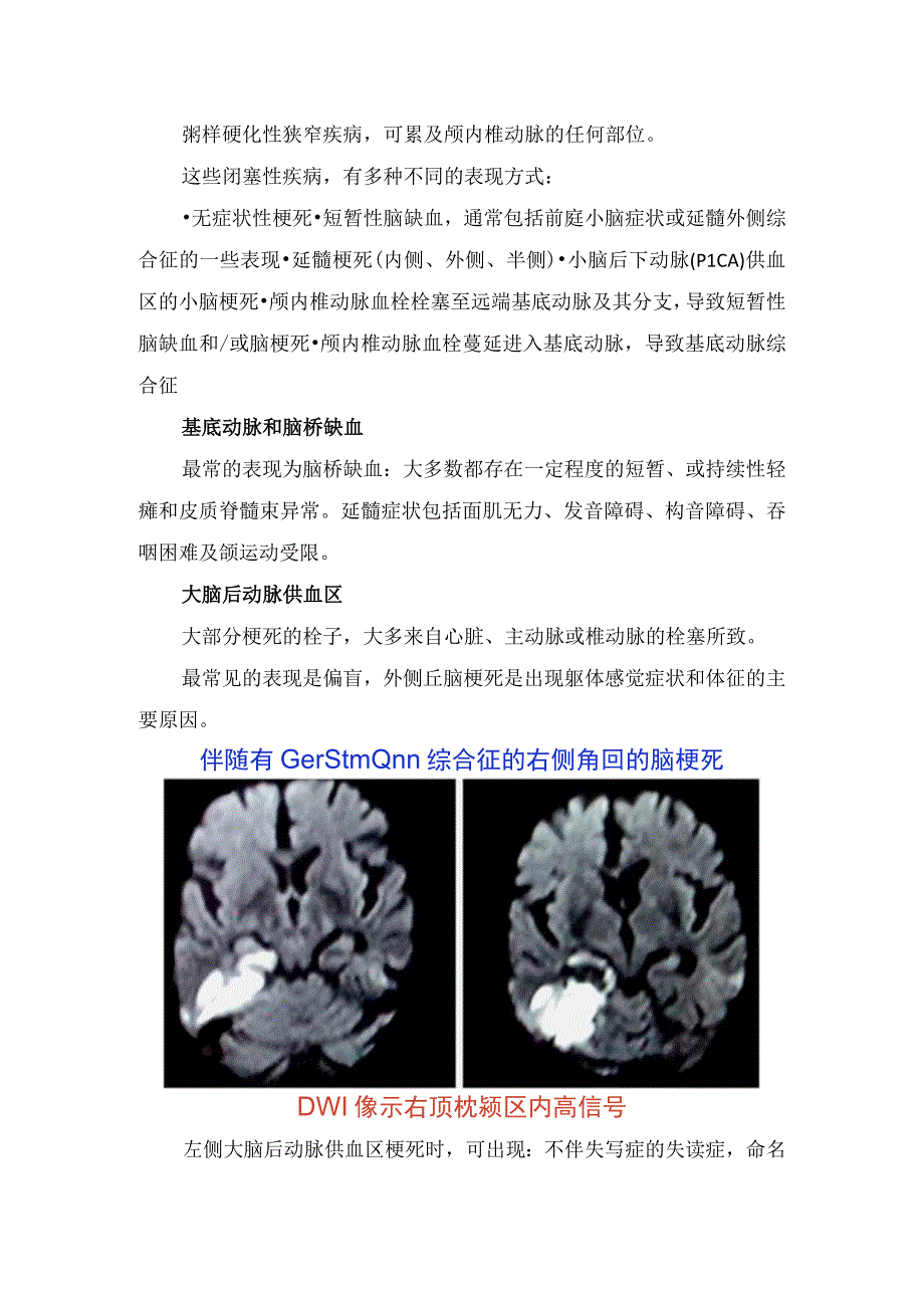 临床后循环脑血管综合征缺血和头晕发病机制及临床表现.docx_第3页