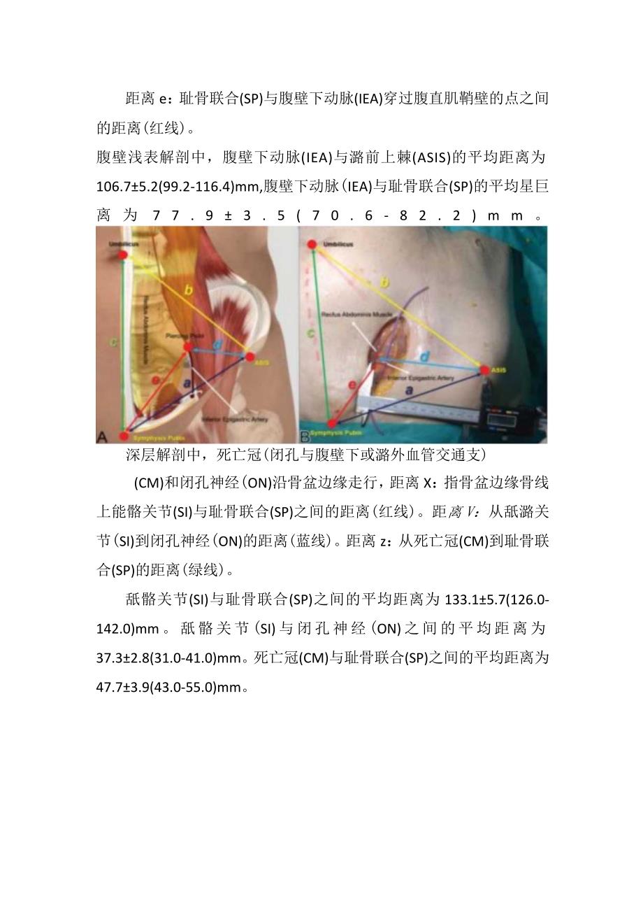 腹直肌旁路径上危险解剖结构体表点位.docx_第2页