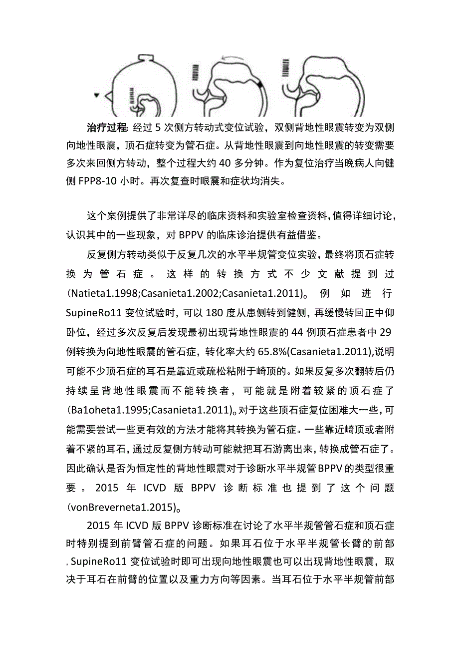 案例讨论：背地性眼震如何转化成向地性眼震？.docx_第2页